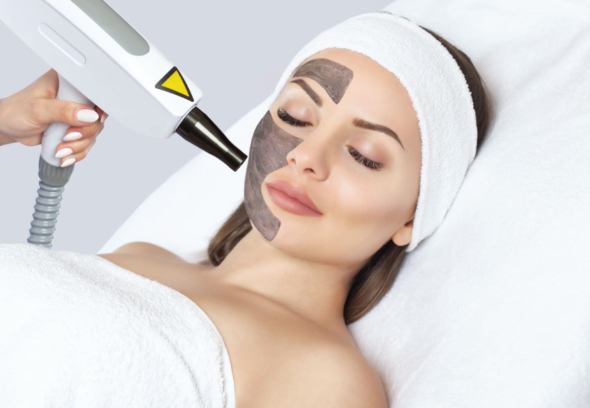 Carbon laser Peel treatment