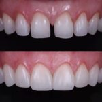 The Intricate Craft of Personalised Smile Adjustments with Composite Bonding